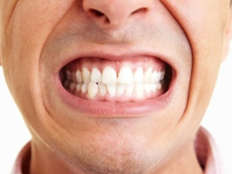 Diş Sıkması (Bruxism)